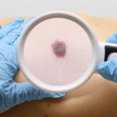Looking at a mole